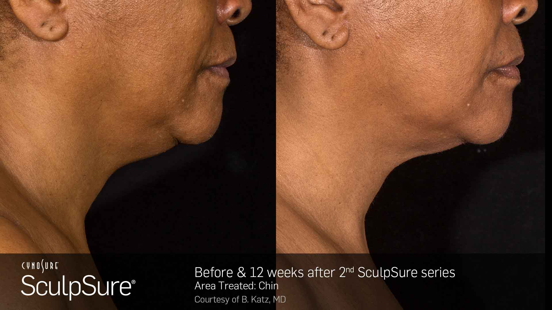 Laser Body Contouring - Before and After
