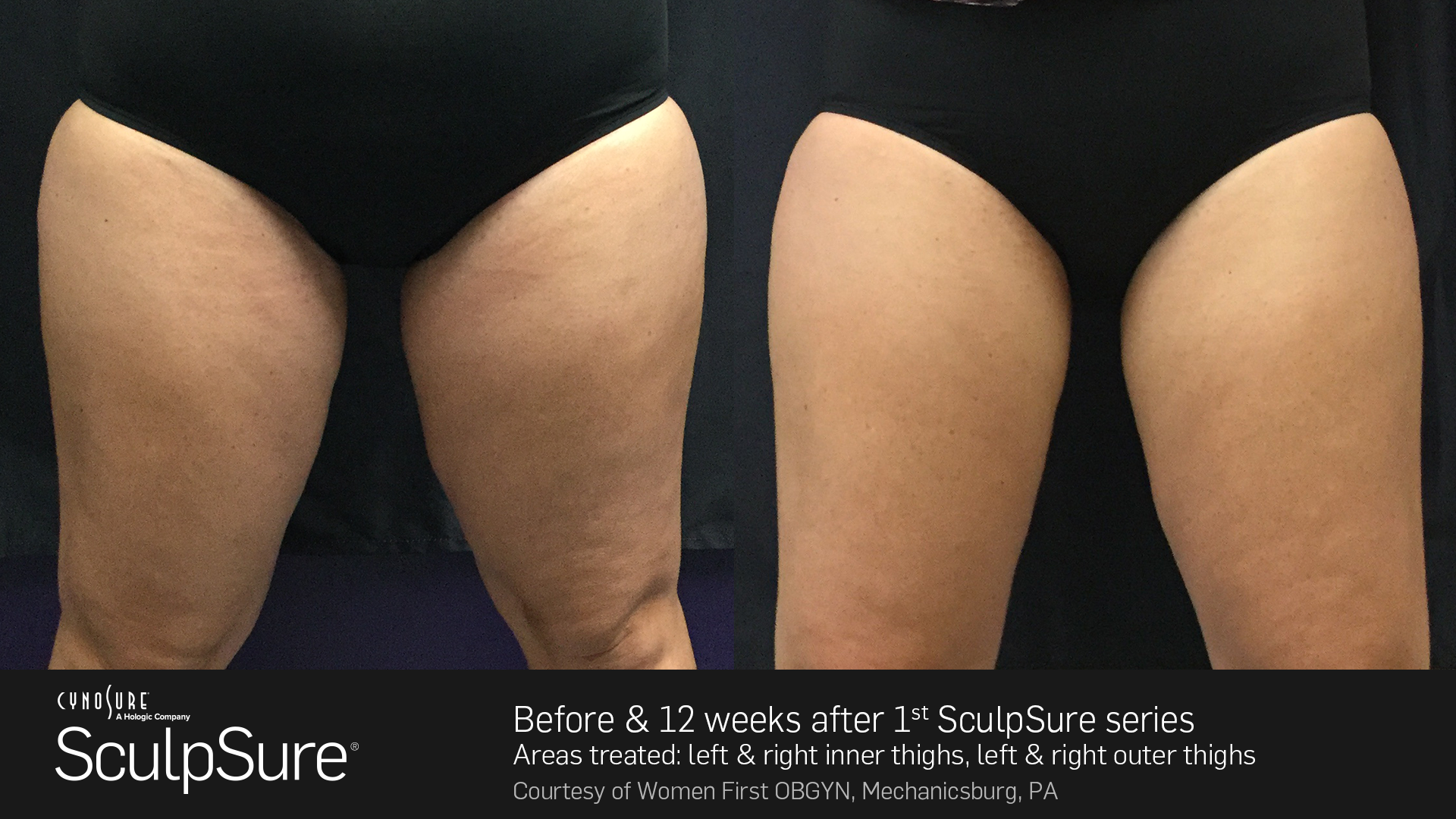 https://www.sculpsure.com/wp-content/uploads/2018/06/Courtesy-of-Women-First-OBGYN_Mechanicsburg_PA_nobadge-1.png
